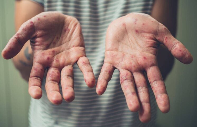 Sarampión y dengue son alta amenaza para el país este año