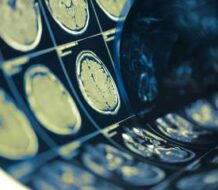 Día Internacional de los Tumores Cerebrales: causas y riesgos