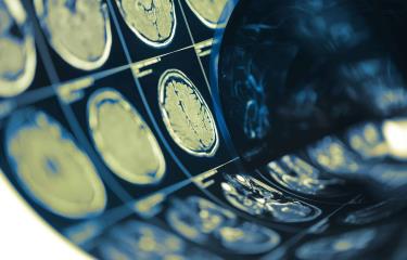 Día Internacional de los Tumores Cerebrales: causas y riesgos