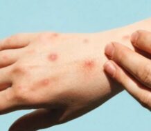 Detectan el primer caso de la nueva variante más peligrosa de mpox fuera de África