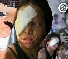 Yocairi Amarante, víctima del ácido del diablo sueña con volver a ser la misma