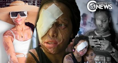 Yocairi Amarante, víctima del ácido del diablo sueña con volver a ser la misma