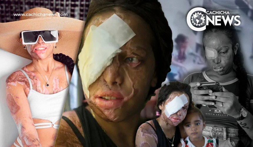 Yocairi Amarante, víctima del ácido del diablo sueña con volver a ser la misma
