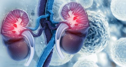 En el país se diagnostican 152 casos de cáncer renal, según estudio
