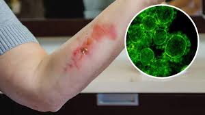Cero mariscos crudos: Sociedad infectología emite recomendaciones por bacteria carnívora